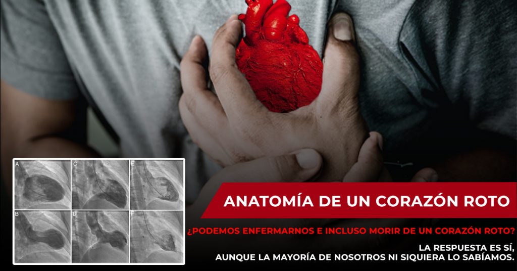 - Miocardiopatía de Takotsubo