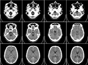 Proteínas acumuladas en cerebro - Proteínas acumuladas en cerebro