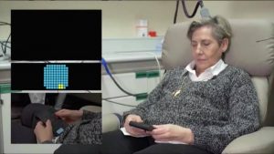 Implante cerebral permite - Implante cerebral permite