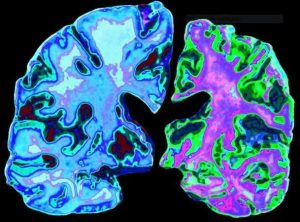 Proteínas acumuladas en cerebro - Proteínas acumuladas en cerebro