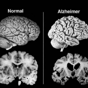 Alzhéimer - Alzhéimer