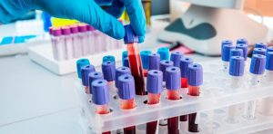 Alzhéimer - Alzhéimer