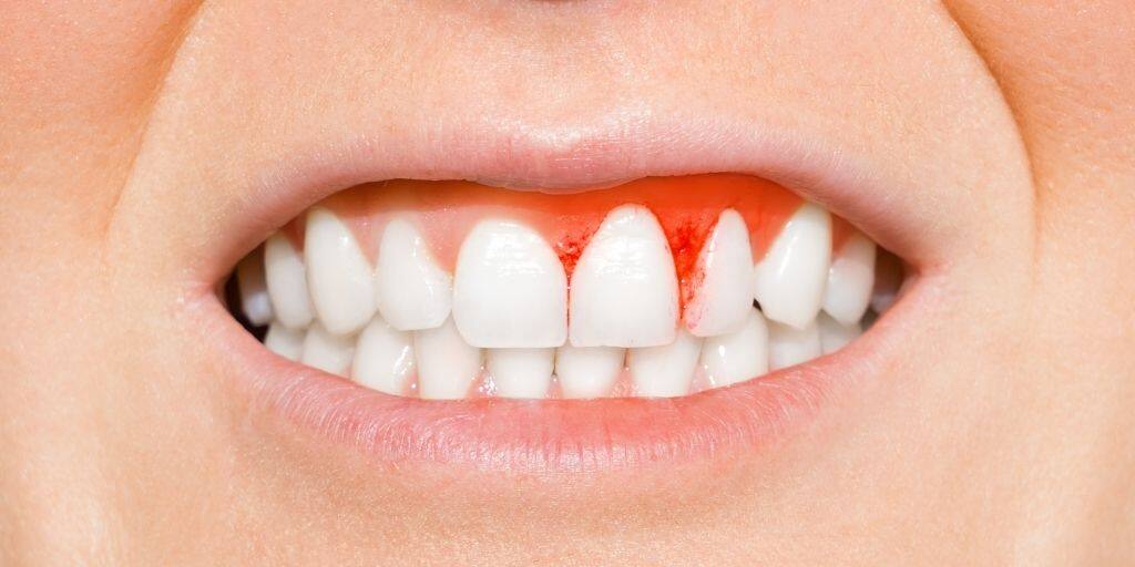 Cómo eliminar el sarro de los dientes: La guía definitiva para deshacerte de este problema 2 Cómo eliminar el sarro de los dientes: La guía definitiva para deshacerte de este problema