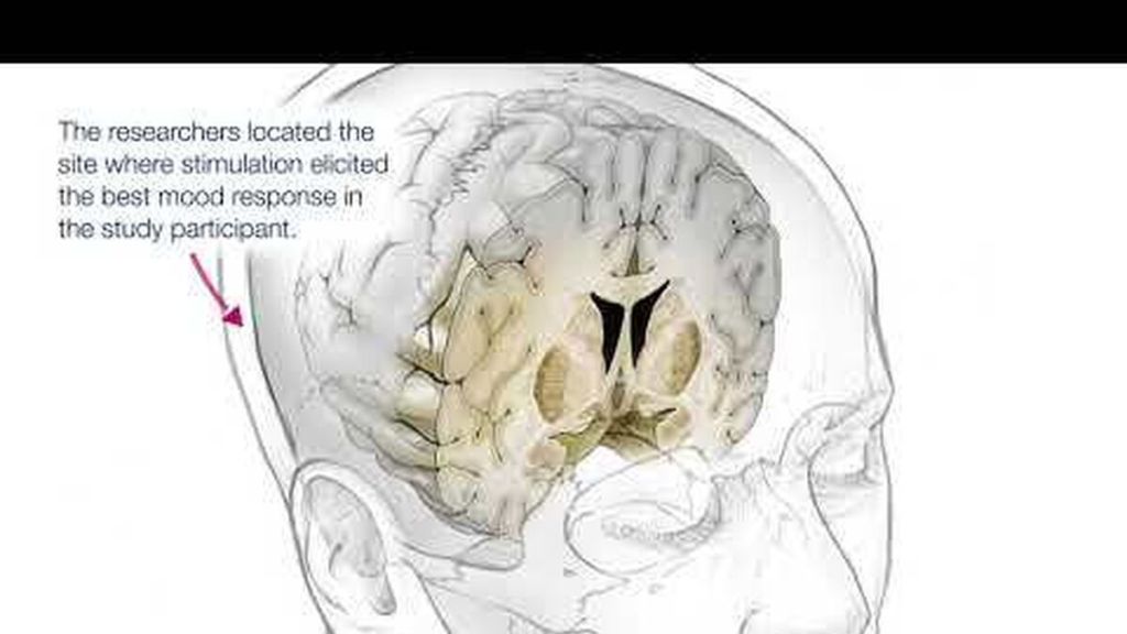 Implante cerebral para tratar la depresión severa