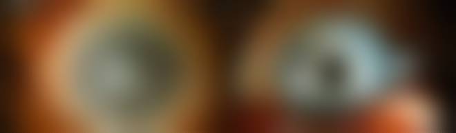 La Queratoprótesis explicada: Un avance en la Cirugía Ocular 2 queratoprótesis - queratoprótesis