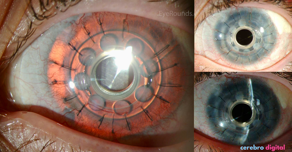 La Queratoprótesis explicada: Un avance en la Cirugía Ocular 1 queratoprótesis - queratoprótesis