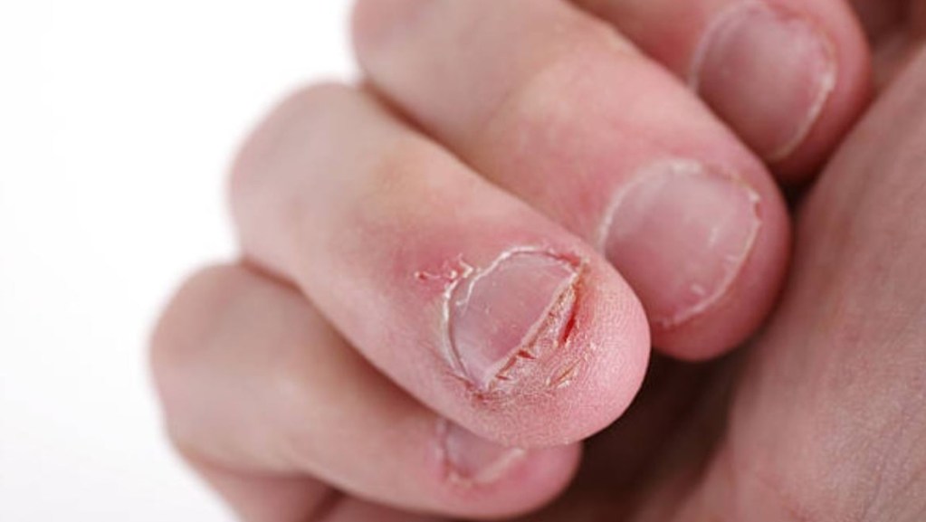 Morderse las uñas: las graves consecuencias para nuestra salud
