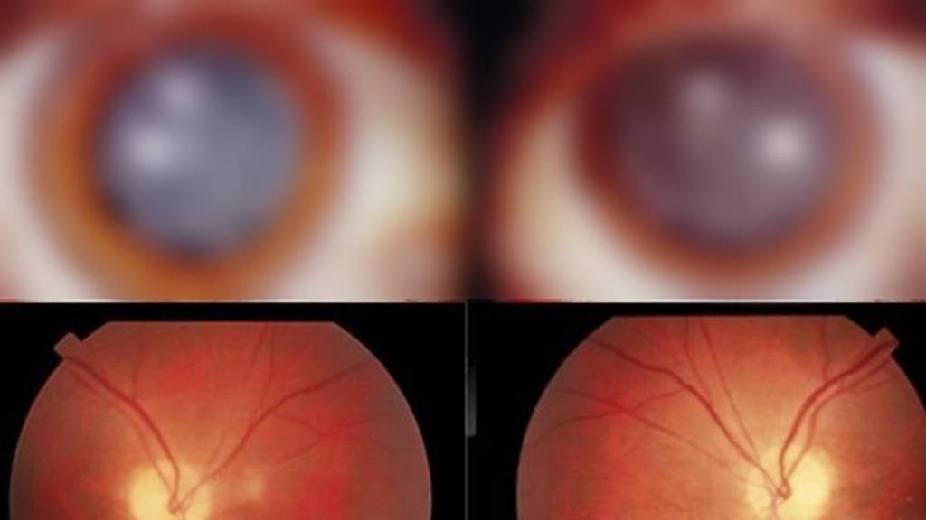 Cataratas en forma de estrellas: la extraña forma que provocó una descarga de 14,000 voltios