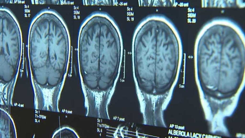 Síndrome de Charles Bonnet: visiones más allá de la realidad