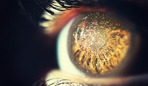 La curiosa enfermedad ocular hialosis asteroide