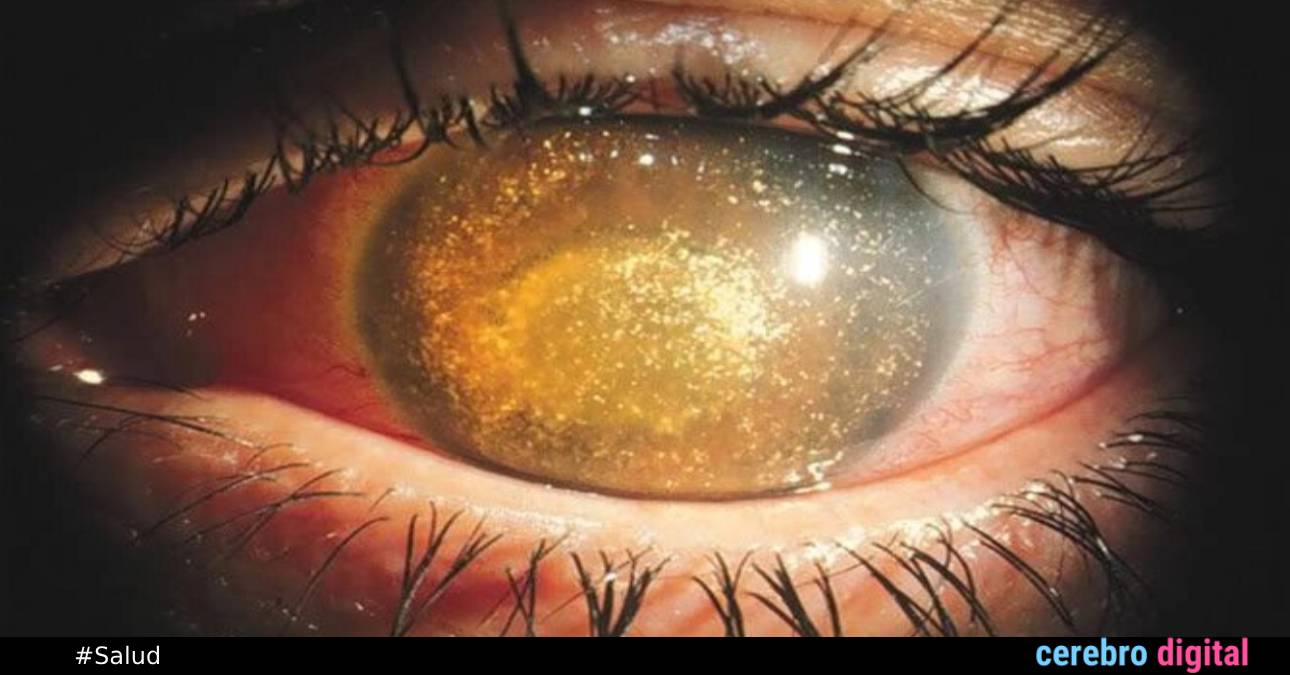 La curiosa enfermedad ocular hialosis asteroide