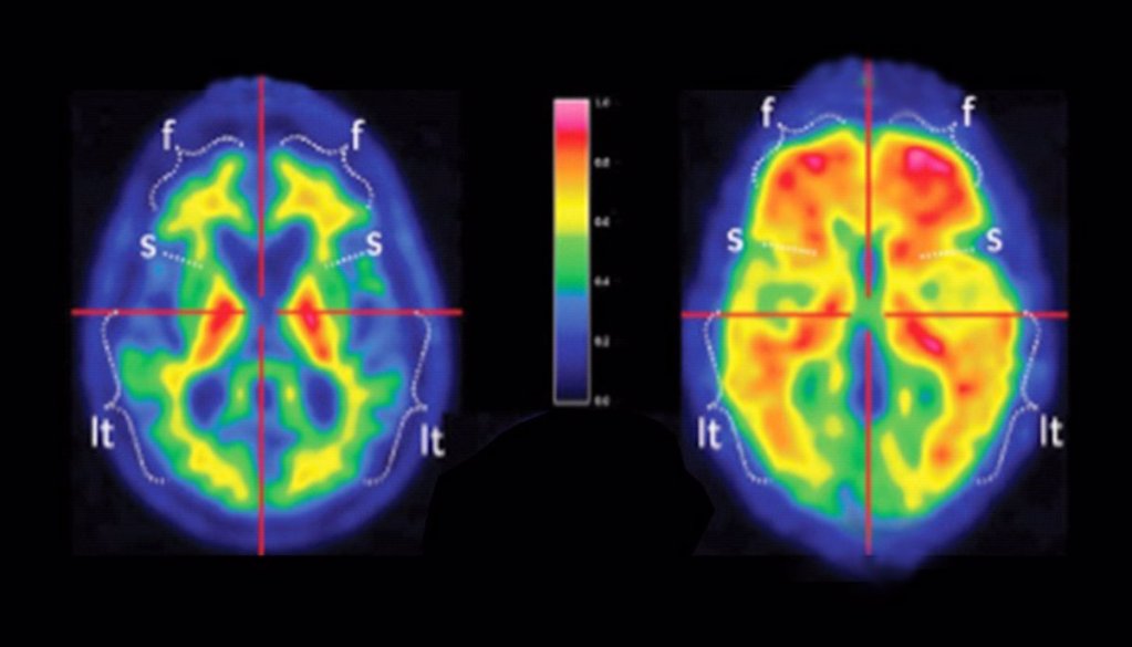 La cura del Alzheimer podría estar en una paciente colombiana