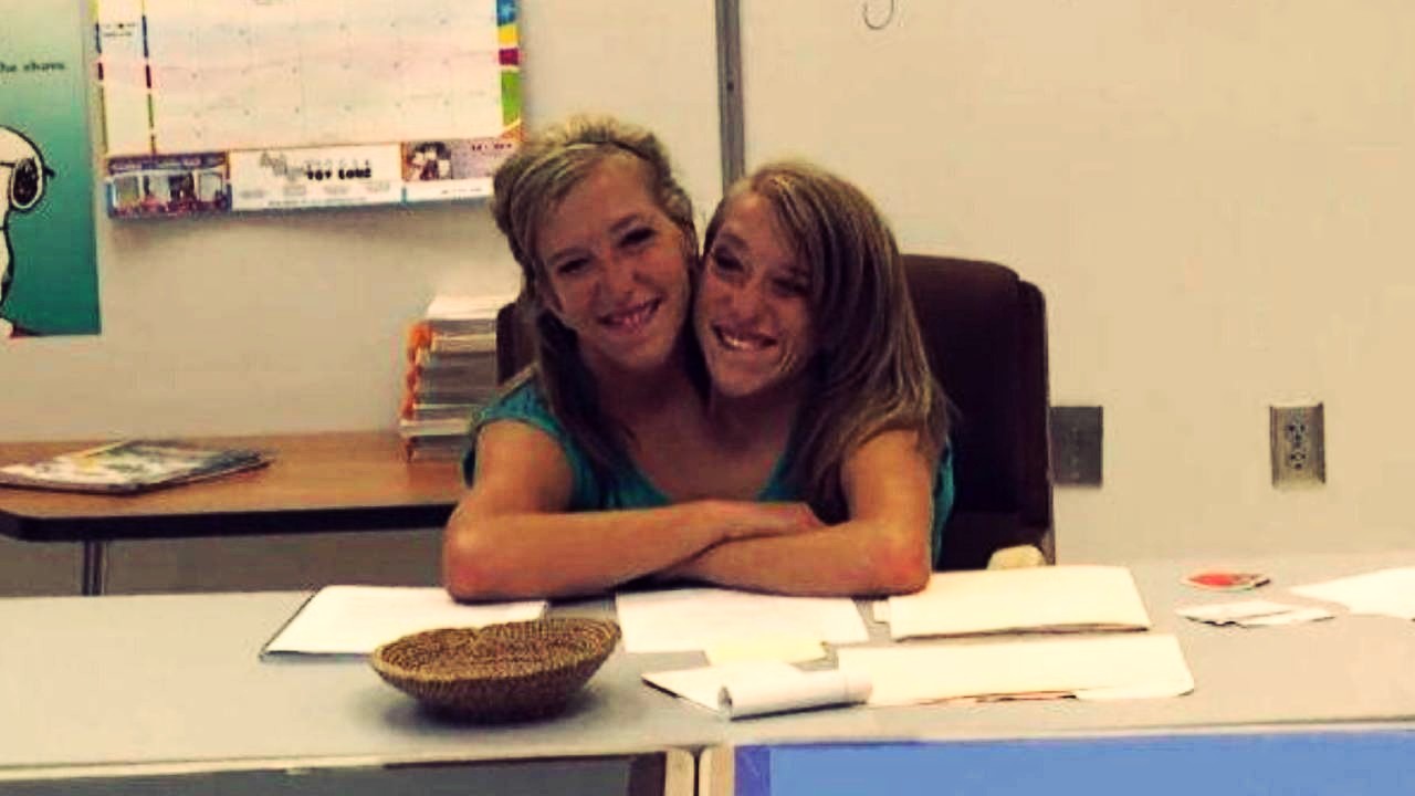 Las famosas gemelas siamesas que comparten su cuerpo: ¿Cómo es su vida en la actualidad?