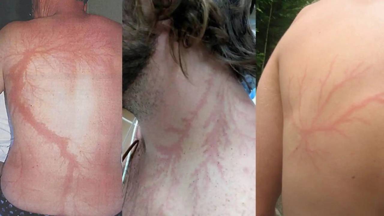 Las figuras de Lichtenberg: Lo que le sucede a tu cuerpo si te cae un rayo