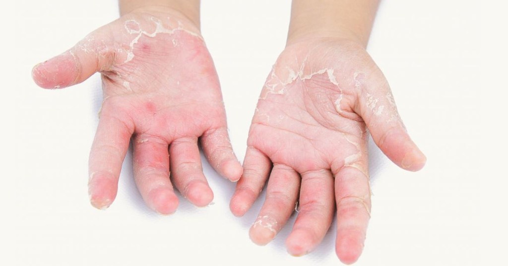 El virus “devorador de anos” está afectando a Japón