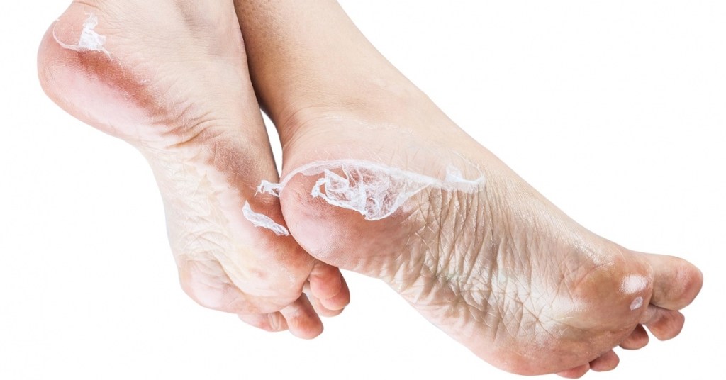 pies escamosos de virus devorador de anos