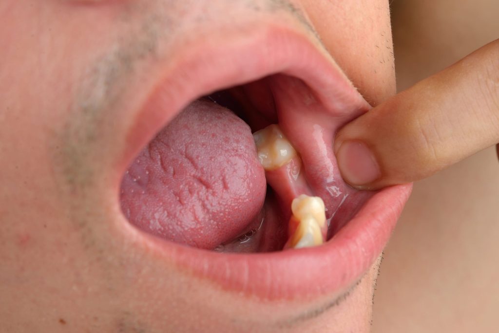 El primer medicamento para la regeneración y crecimiento de dientes se probará en septiembre