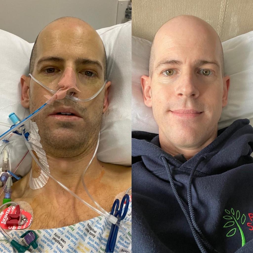 Trasplante de hígado: el increíble cambio de un hombre después de recibir uno