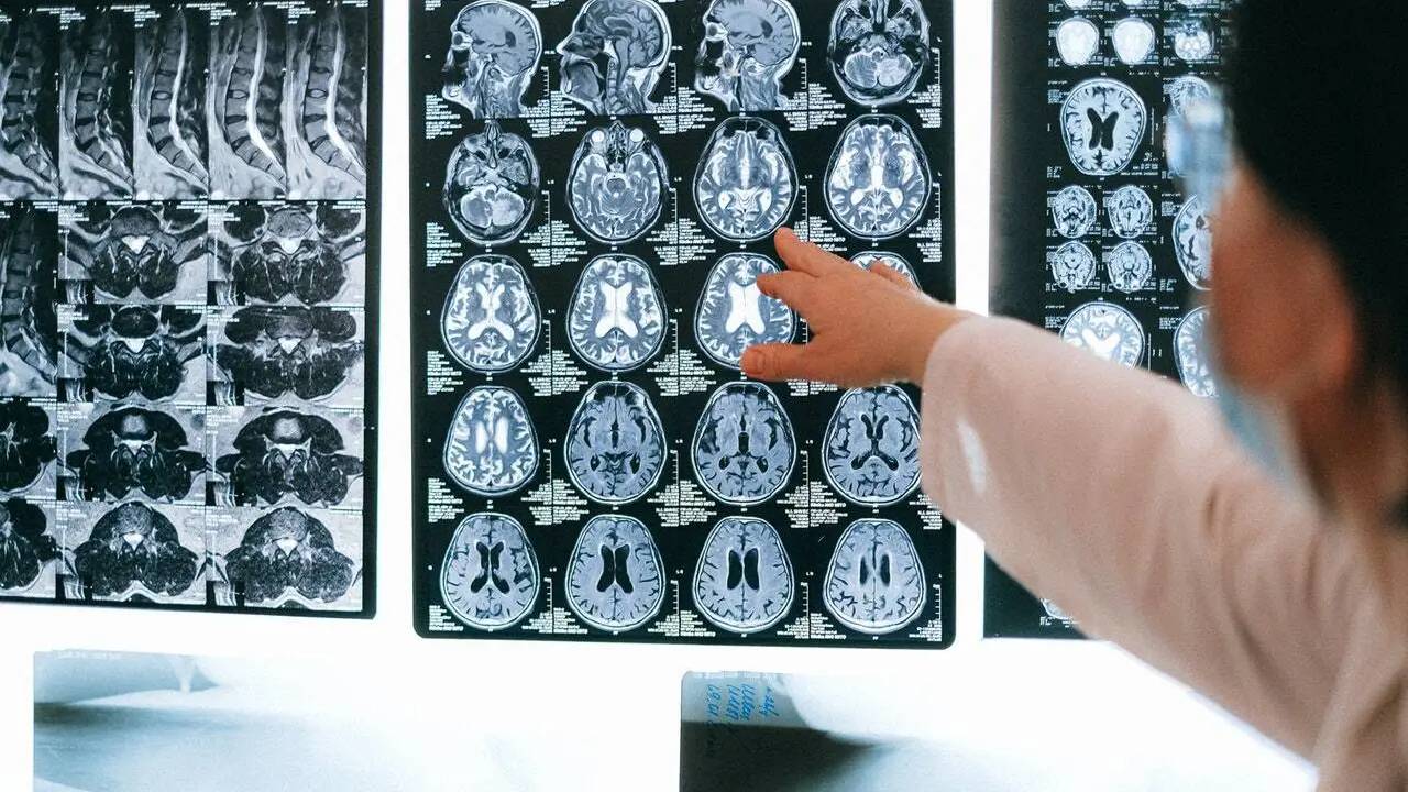 Efectos del COVID-19 a largo plazo generan déficits cognitivos semejantes a dos décadas de envejecimiento