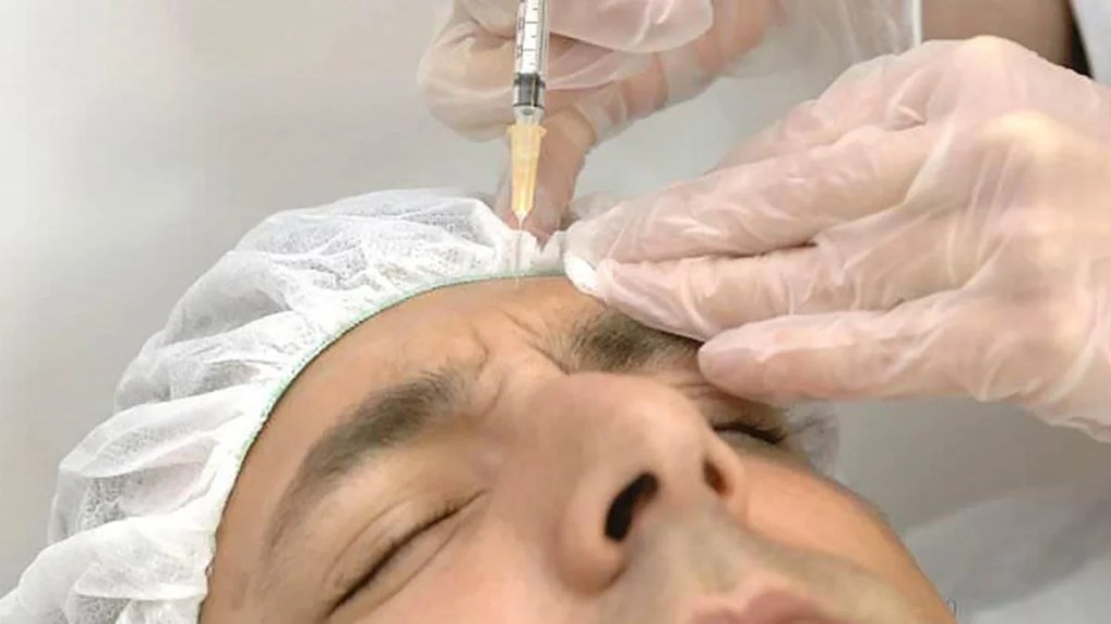 Las inyecciones de Botox en la frente pueden alterar el procesamiento emocional del cerebro