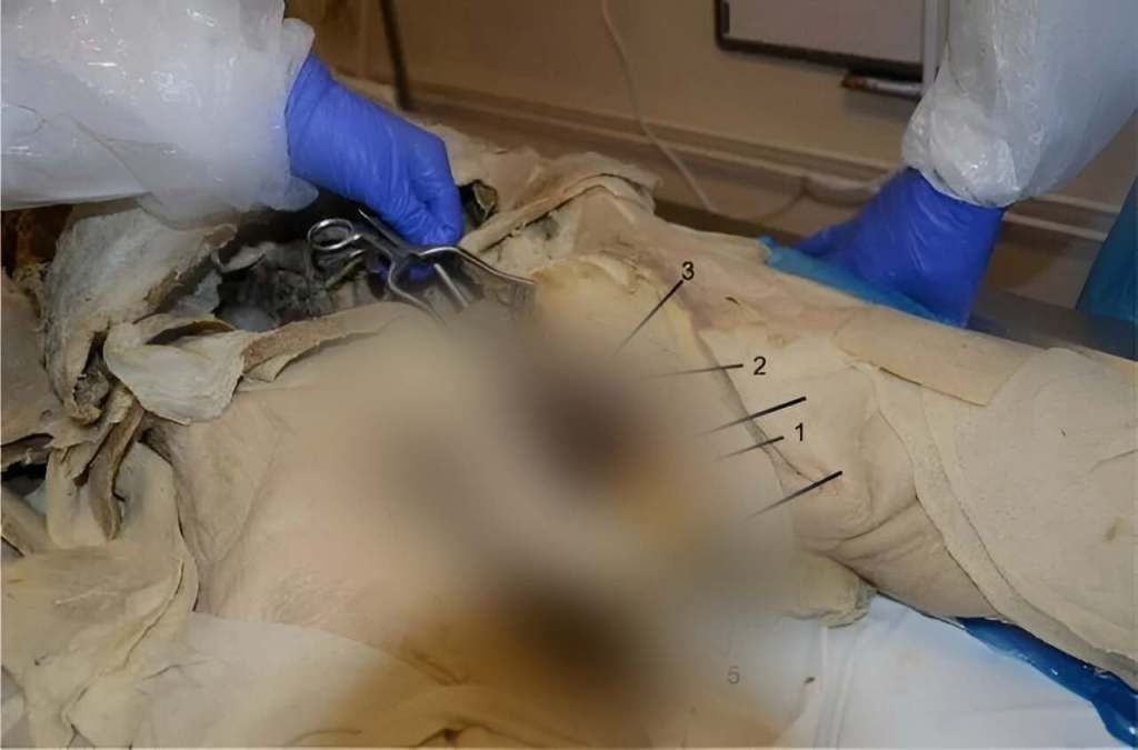 Autopsy Revealed That a 78-Year-Old Man Had 3 Penises: An Extremely Rare Medical Phenomenon 4 penises - penises