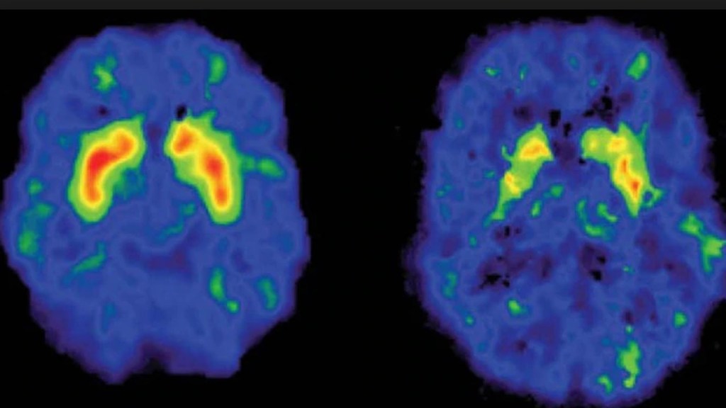 El cerebro de una persona durante el orgasmo se ve igual a cuando consume drogas