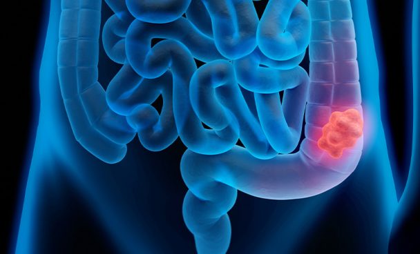 El cáncer de colon en adultos jóvenes crece alarmantemente: síntomas y cómo detectarlo temprano