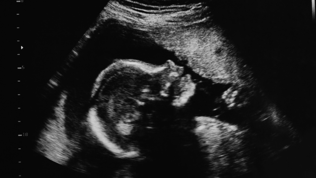 Por primera vez, tratan un raro trastorno genético en el útero y la niña nace sin señales de la enfermedad 1 trastorno,genético - trastorno