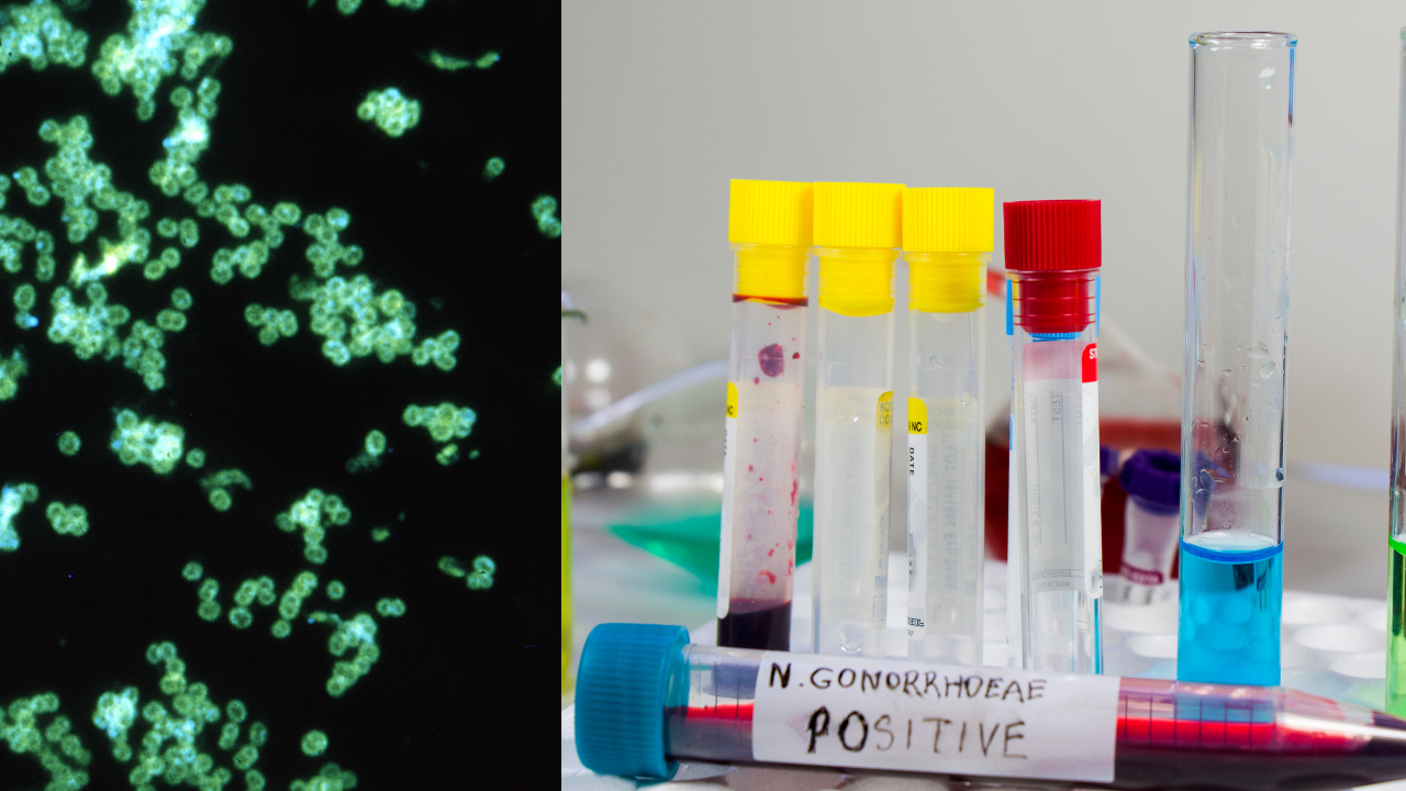 gonorrea