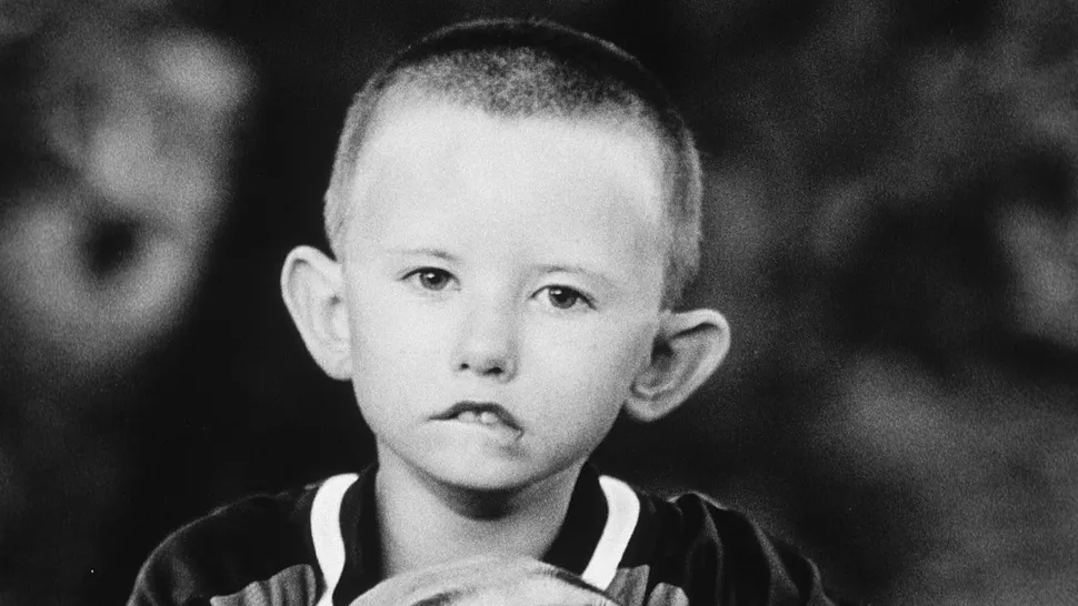 El enigma del síndrome de Moebius: cuando el rostro no puede sonreír 1 Síndrome,Moebius - Síndrome