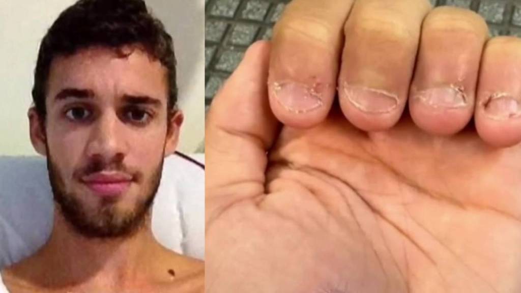 Morderse las uñas casi le cuesta la vida a un influencer peruano