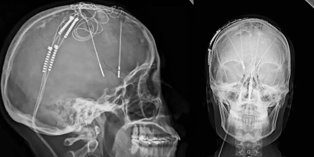 Colombia realiza su primera cirugía cerebral para tratar la depresión