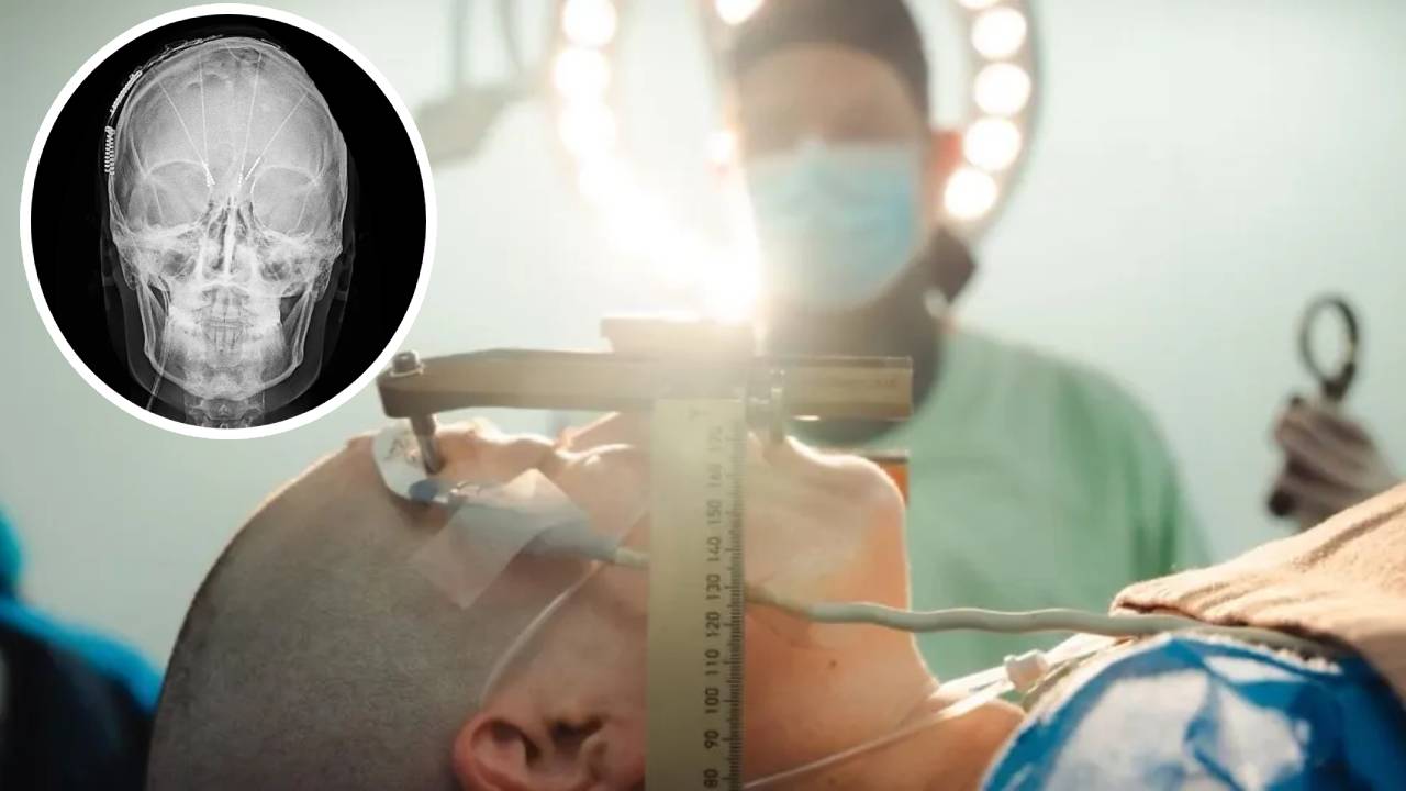 Colombia realiza su primera cirugía cerebral para tratar la depresión