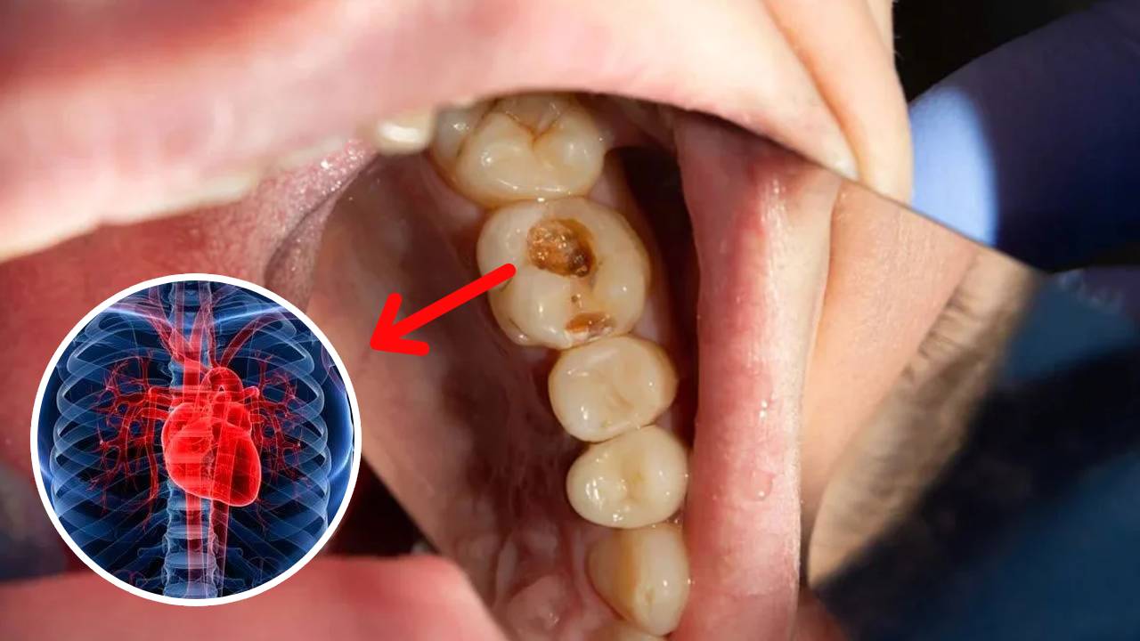 El vínculo entre las caries y las enfermedades cardíacas que casi todo el mundo desconoce