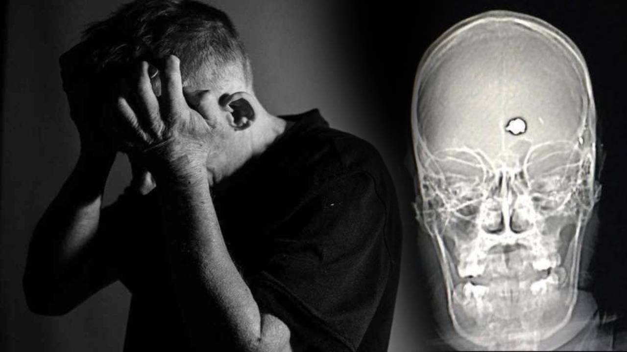 A gunshot to the head cured his mental illness and changed his life