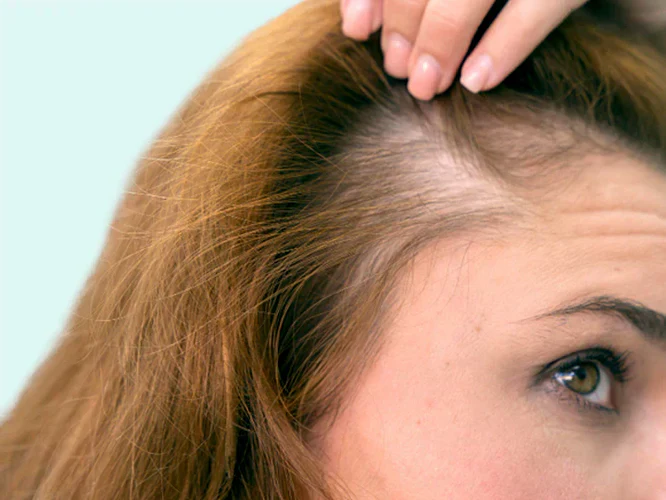 ¿El jugo de cebolla puede detener la caída del cabello?