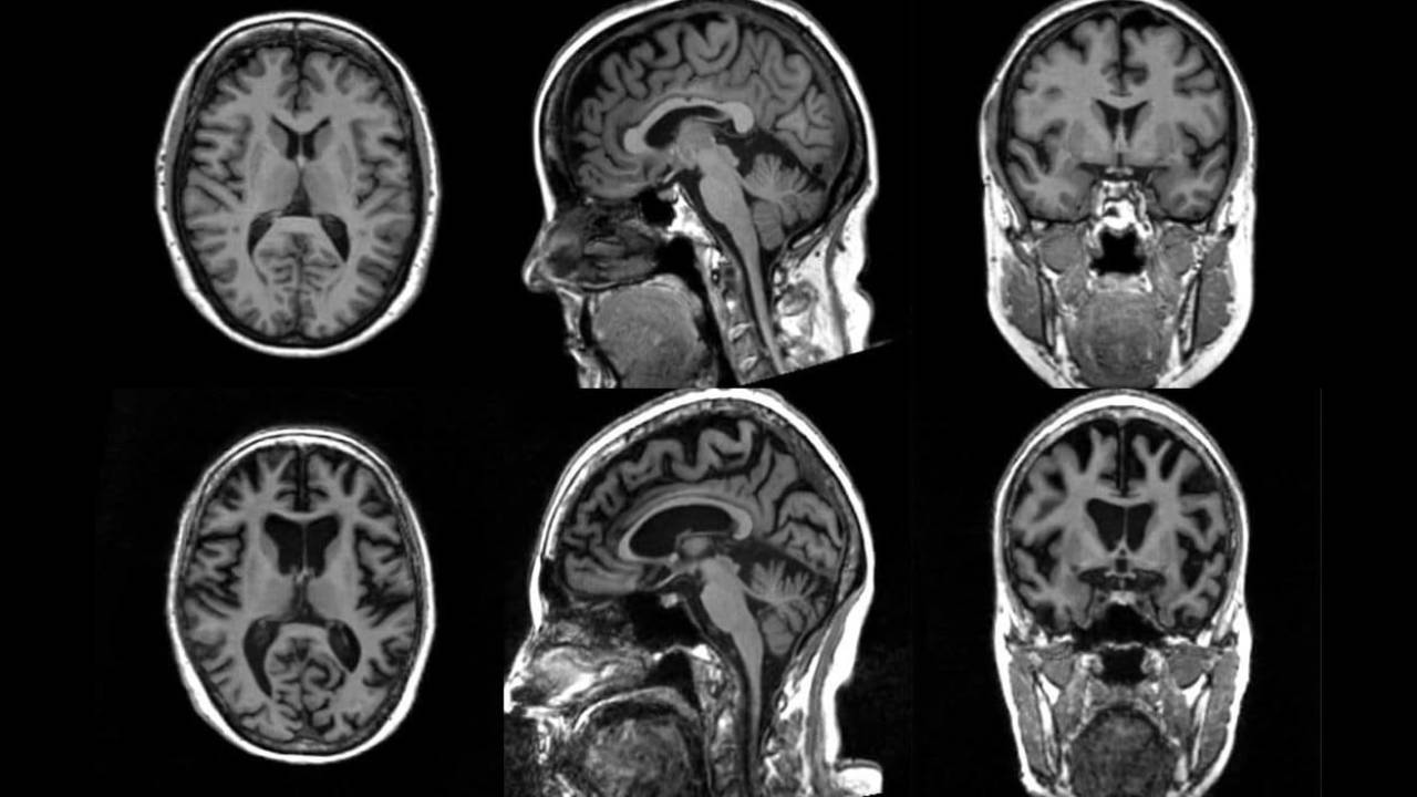 El caso más joven de Alzheimer registrado: un diagnóstico impactante a los 19 años