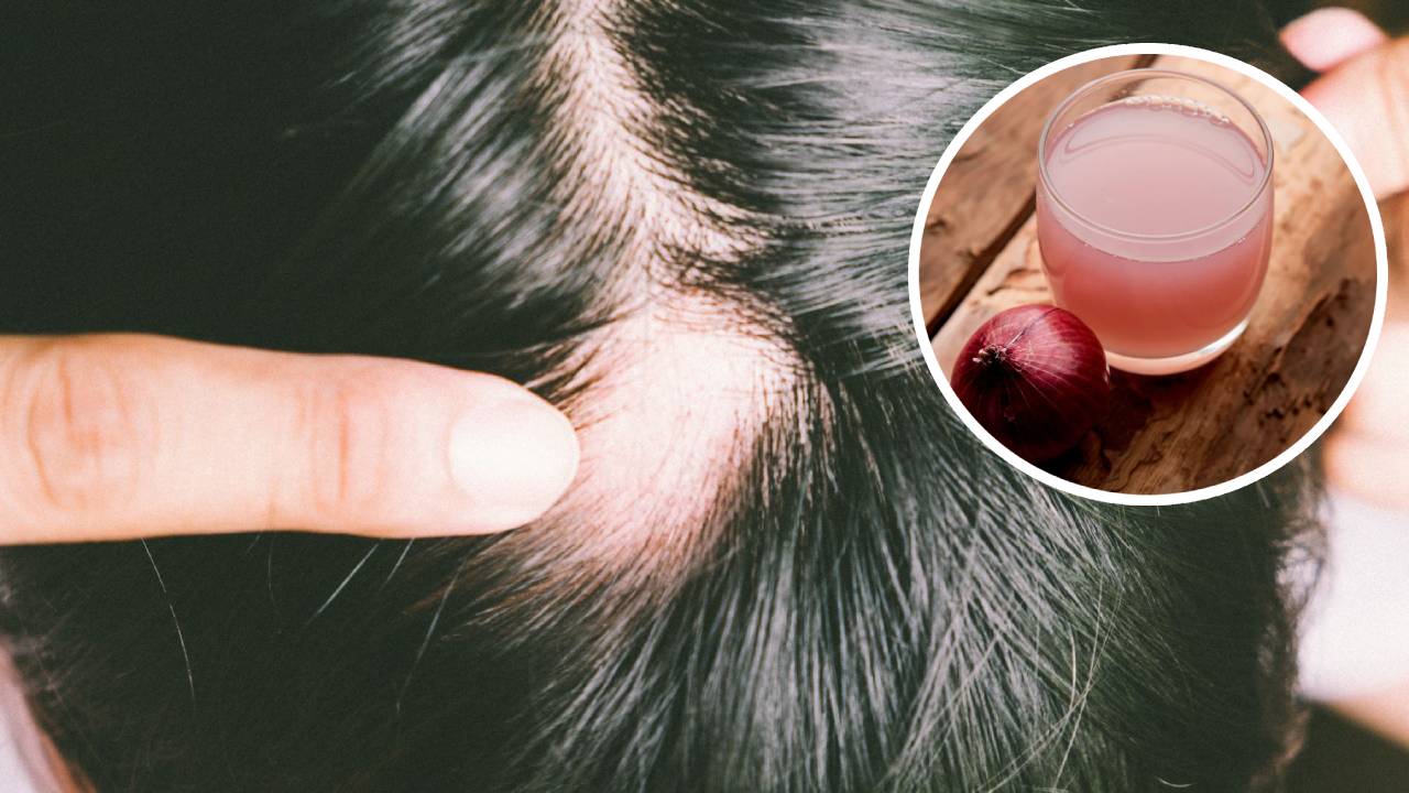 ¿El jugo de cebolla puede detener la caída del cabello?