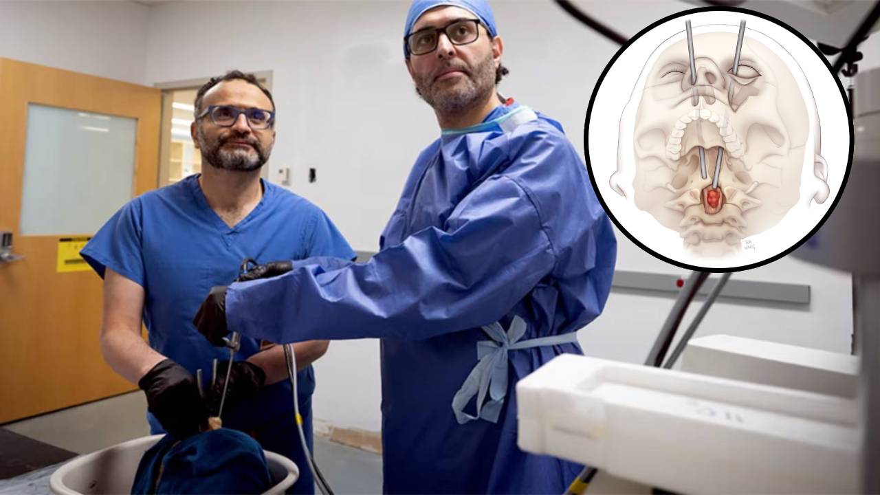 Cirujanos extirpan tumor espinal a través del ojo en una operación sin precedentes