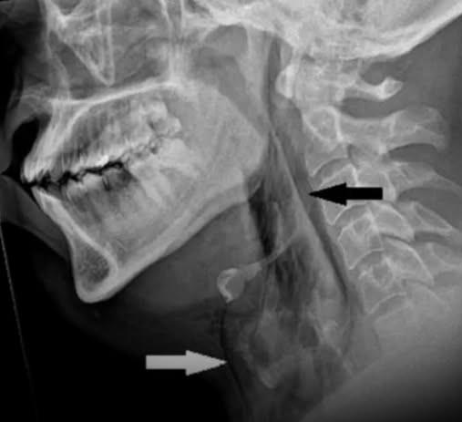 Estornudo - Estornudo