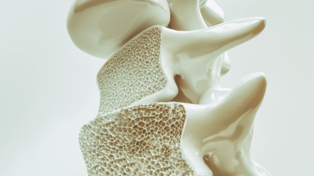 Osteoporosis: el interruptor óseo que promete frenar la enfermedad 1 Osteoporosis - Osteoporosis
