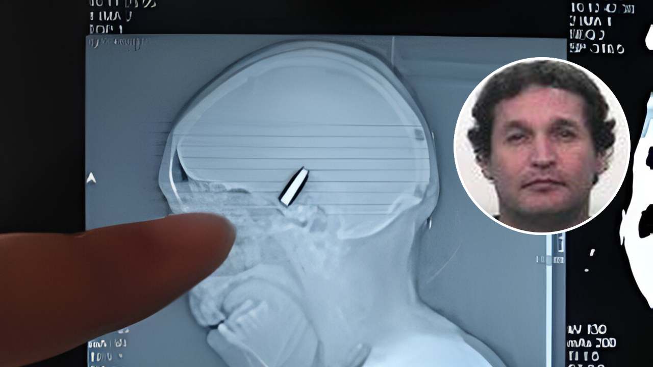 Fue al médico por un dolor de cabeza y descubrió que era una bala