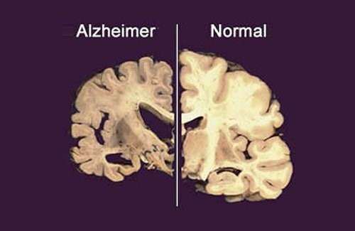 alzheimer - alzheimer
