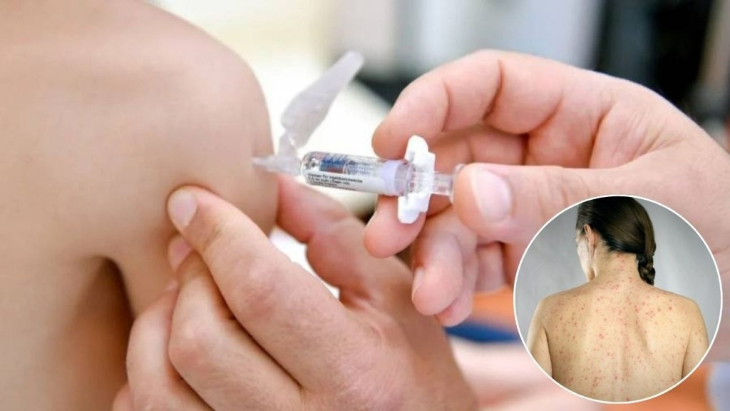 canada,sarampion - canada