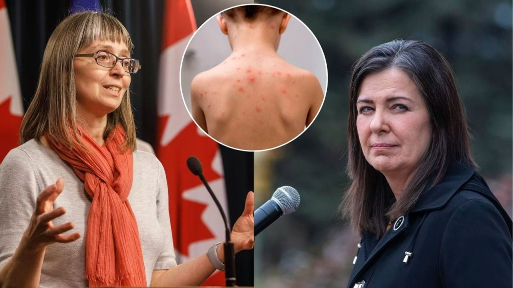 canada,sarampion - canada