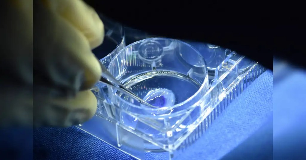 Mujer israelí recupera la visión con el primer implante de córnea impresa en 3D del mundo