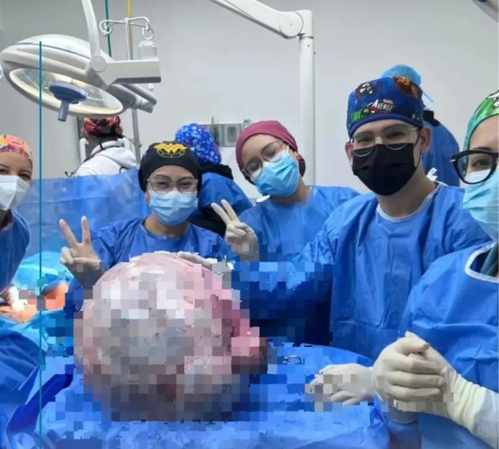 Médicos del Hospital Razetti extraen tumor de 25 kilos a una mujer de 52 años en Venezuela 1 tumor - tumor