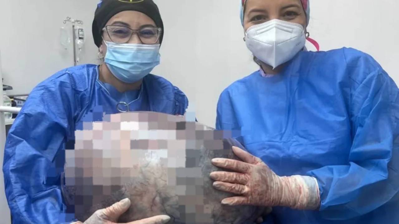 Médicos del Hospital Razetti extraen tumor de 25 kilos a una mujer de 52 años en Venezuela