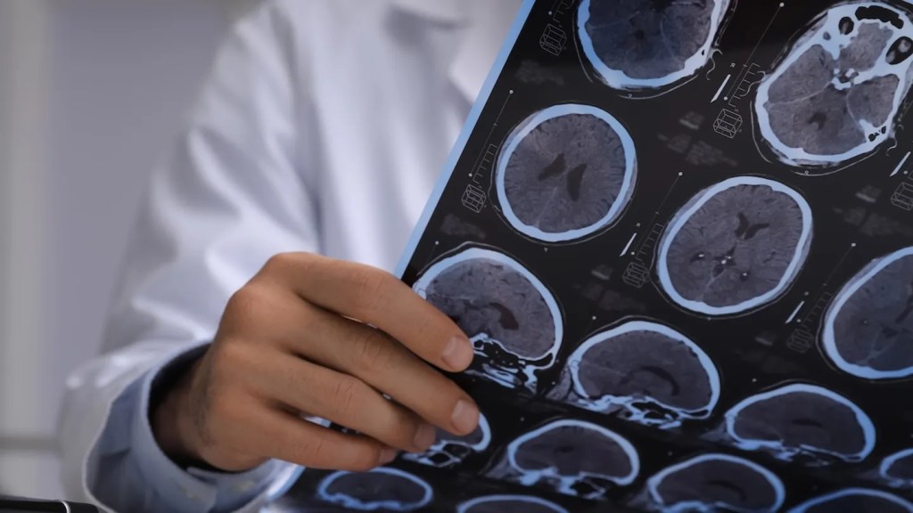 Creían que tenía cáncer cerebral, pero descubrieron tenias vivas alojadas en su cerebro 2 cancer cerebral - cancer cerebral