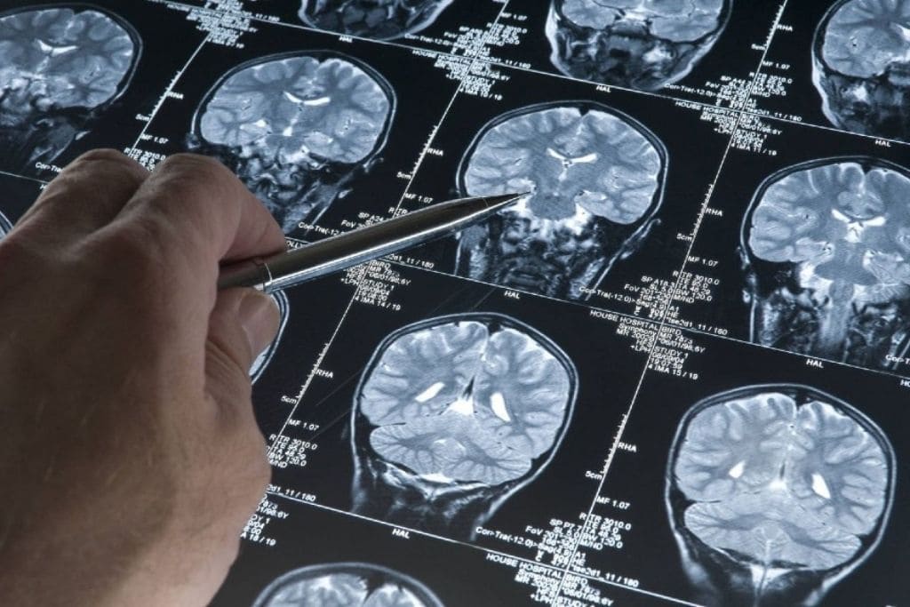 alzheimer - alzheimer